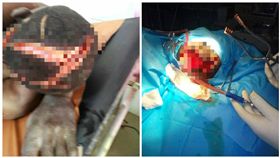 奈及利亞農民奧古斯丁（Augustine Mnyin）頭部被砍出一道長達20公分的刀痕竟奇蹟痊癒（圖／翻攝自臉書）
https://www.facebook.com/oscar.aorabee/posts/1852061671534573