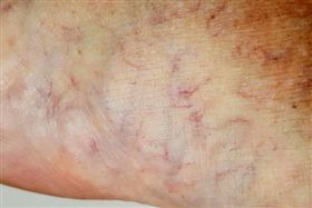 澳洲,越南,鉤蟲,寄生蟲,入侵,感染　圖／翻攝自澳洲新聞網