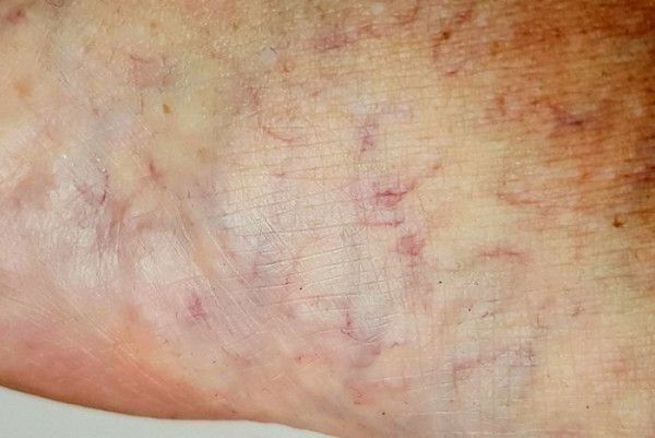 澳女赤腳走沙灘　慘遭寄生蟲入侵體內