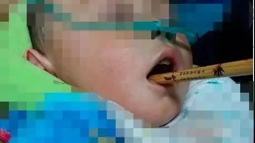 1歲童吃飯跌倒　竹筷從口中直插顱內