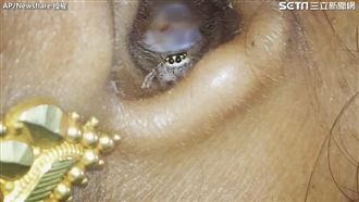 睡醒耳朵痛　醫生強光一照蜘蛛藏深處