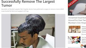 印度男子腦部腫瘤重達1.87公斤（圖／翻攝自mumbailive.com）