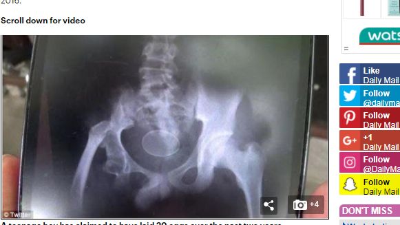 少年竟會生蛋？醫生看到一半滑出兩粒