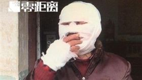 大陸江蘇一名75歲劉姓女子日前聽到家中狗狗不斷吠叫，上前查看後看到狗狗咬著一顆祝壽氣球，當時劉女正在抽煙沒有多想，就用拿著香煙的手拿起氣球，不料竟發生爆炸，導致她的臉部和手部炸傷；對此，劉女的家人希望快找到氣球的主人，並為該起爆炸事件負責。（圖／翻攝自微博）