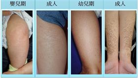 成大醫院,皮膚部,醫師,李兆甯,魚鱗癬,基因,遺傳,脫屑