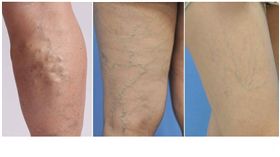 長庚醫院及長庚大學最新的研究發現，靜脈曲張患者產生深層靜脈栓塞是正常人的5.3倍，產生肺栓塞是正常人的1.73倍，產生周邊動脈疾病是正常人的1.72倍。（圖／長庚醫院提供）