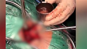  男子全身長滿寄生蟲　蟲卵覆蓋大腦神經(圖/翻攝自梨視頻)