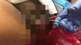 影／慎入！腋下大膿包一劃開…爆漿流出、鮑魚臭味衝腦門 ▲（圖／翻攝自 Michael Lewis, MD Youtube）