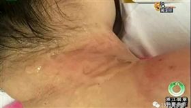 大陸浙江嘉興一名付姓女子，去年到一家美容院拔罐，不久後她竟聞到烤肉味，才驚覺自己的脖子被燙傷，害得她晚上做夢都在哭。付女要求對方賠償5萬人民幣（約新台幣23萬元），但業者只願賠償2萬（約新台幣9.2萬元），最後付女打算透過法律途徑解決。（圖／翻攝自搜狐）