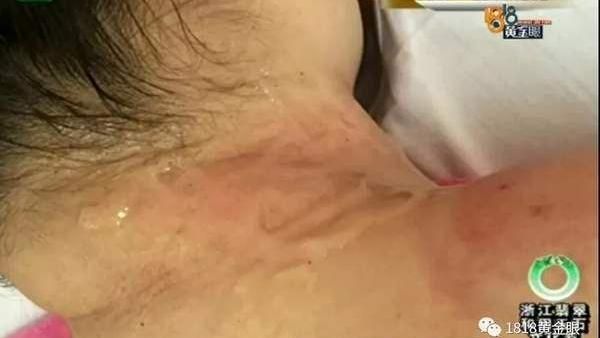 拔罐飄出烤肉味　女驚：脖子燒起來了