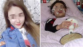 大陸天津一名25歲陳姓女子是一名愛狗人士，日前她看見一隻流浪狗，蹲下伸手撫摸牠時，突然被狗咬爛臉部。由於陳女的傷口暴露時間超過10個小時，有可能引起病毒感染，目前仍在醫院治療當中。（圖／翻攝自中國經濟網）