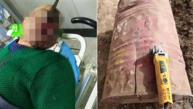 驚悚慎入！強國男遭鐵片劈頭　直插眉心
翻自《網易》