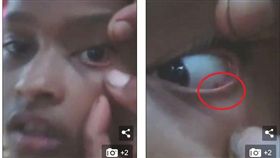 印度一名11歲女童阿什威妮（Ashwini），她的眼睛出現刺痛感，就醫後仍沒改善，更可怕的是，她的眼睛慘變「螞蟻窩」，10天內爬出60隻螞蟻。醫師推斷螞蟻可能從她的耳朵鑽入，但還沒找到確切原因。（圖／翻攝自每日郵報）