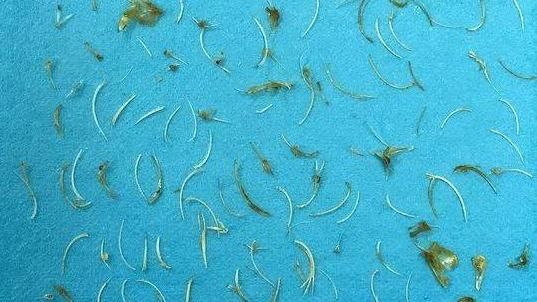 吃魚連骨吞下　百根魚刺插滿直腸壁