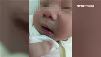 寶寶嘴唇瘀青結痂　母控月子中心粗心