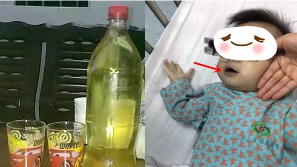 喝了珍藏3年冬瓜水　3兄弟中毒發紫