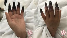 手指發黑枯枝。（翻攝自楚天都市報微博）