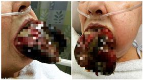 豬肝掛嘴邊？慎入！女子舌頭被蜘蛛咬到　慘況令人毛骨悚然
圖／翻攝自IG HealMeDoc