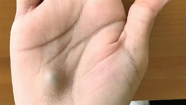 看牙後手掌冒藍色腫塊　竟是心臟病了