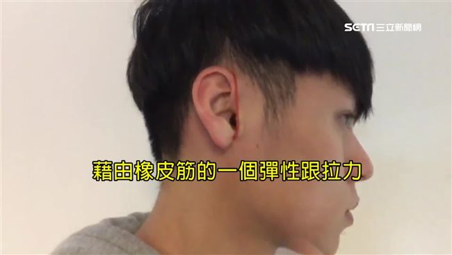 橡皮筋綁耳朵瘦臉　醫：不如醫美