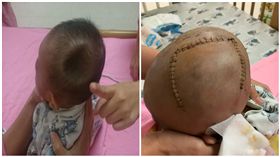 沒用安全座椅被撞來撞去　4月大男嬰頭像「蘋果被咬一口」