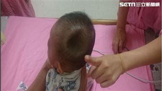 男嬰凹頭像蘋果咬一口　父自撞釀禍