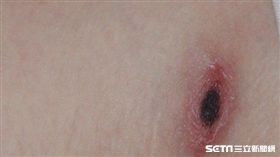 恙蟲病叮咬處呈現無痛性的焦痂樣。（圖／台北市衛生局提供）