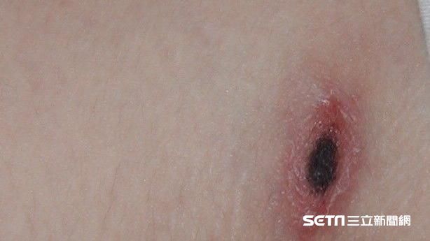 致死率6成！清明防恙蟲　突發燒注意