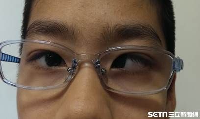 鬥雞眼致雙眼弱視　3歲前治療變正哥