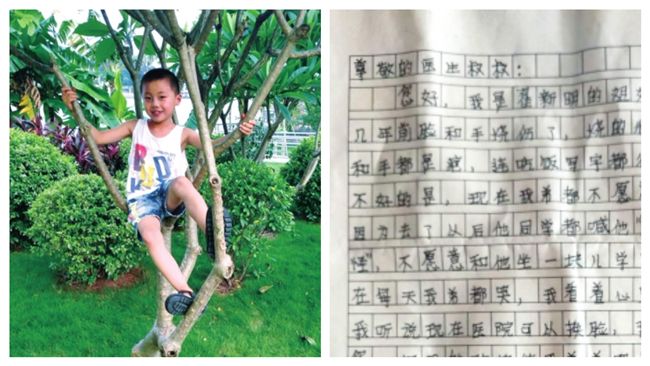 弟燒傷毀容　姊淚求醫：把我臉換給他