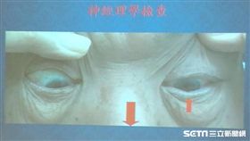 書田診所腦神經內科主任黃啟訓說，引發無疼痛突發性眼球歪斜常見的重要因素有：糖尿病、腦血管瘤壓迫、急性腦幹中風。（圖／記者楊晴雯攝）