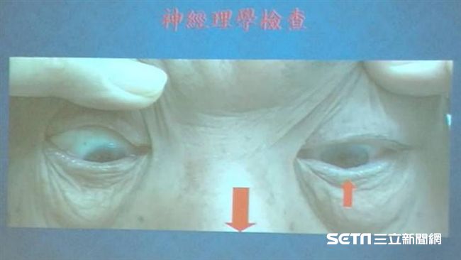驚！他眼睛「脫窗」　竟是腦袋長東西
