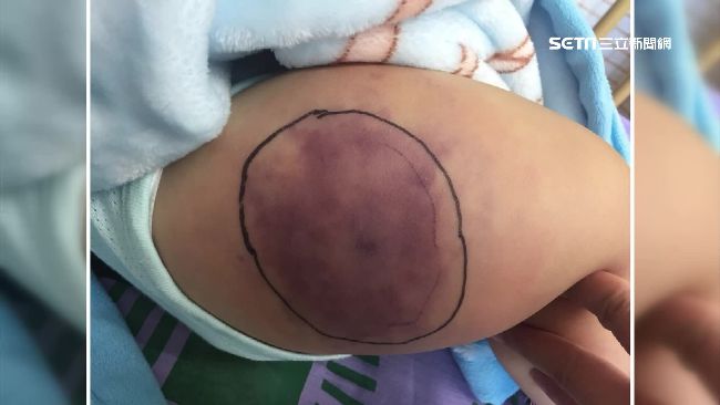 童染綠膿桿菌身亡　疑與種族體質有關