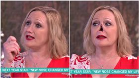 Jayne Hardman,鼻子,義鼻,傷口,韋格納肉芽腫／This Morning
 YouTube