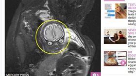 16:9
產前拍一張核磁共振　孕婦崩潰潰：為什麼有外星人QQ
圖／翻攝自The Sun
https://www.thesun.co.uk/fabulous/6034247/couple-shock-mri-scan-mars-attacks-martian/