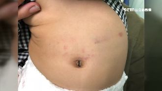 嬰坐副駕出車禍　安全帶緊勒脾裂出血