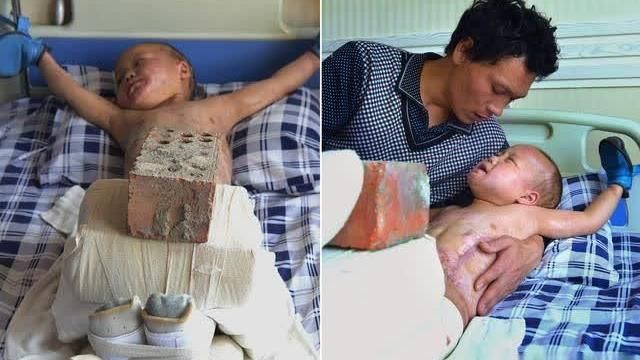 5歲兒全身燒傷　父狠拿磚壓腿綁雙手