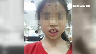 女童遭同學絆倒撞斷牙　母怒告討公道
