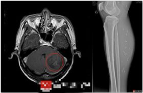 大陸,廣東,豬肉,蟲,腦囊蟲,絛蟲,感染(圖/翻攝網易)