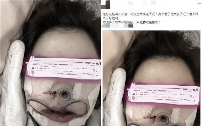 貼正顎手術照嘆痛苦　網友集氣暖爆她