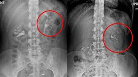 美國女子腎臟「亂飄」／YouTube