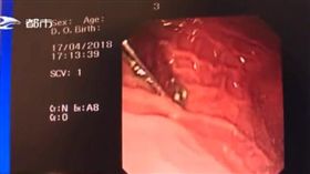 16:9
幫1歲半寶寶剪指甲　6公分指甲刀竟被寶寶一口吞下肚
圖／翻攝自騰訊
https://v.qq.com/x/page/y06320gl9xq.html