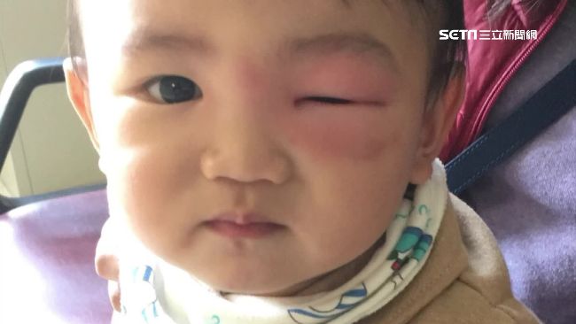 蚊子咬一口　2歲嬰左眼腫脹像麵龜