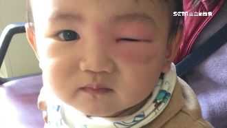 蚊子咬一口　2歲嬰左眼腫脹像麵龜