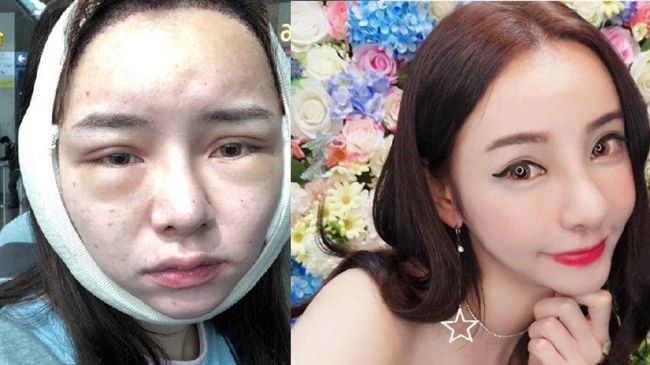 女星赴韓整形　藥物過敏返台就醫