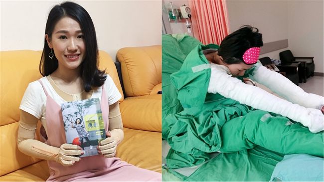 曾痛到絕望　空姐塵爆重傷後重生