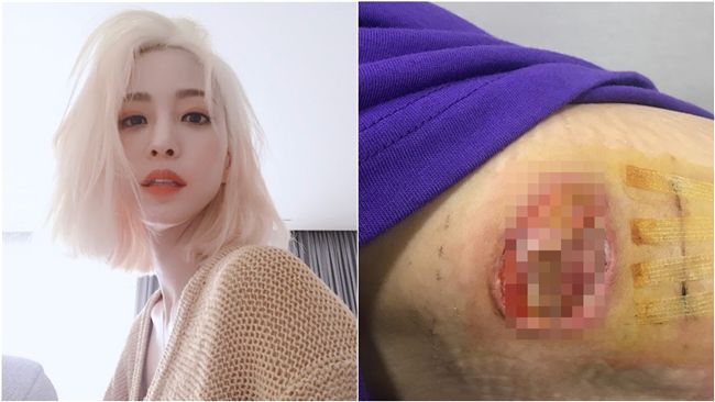女星痛揭醫療事故　噁心傷口再惡化