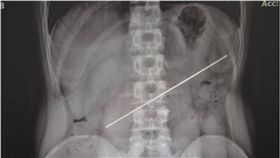 得不償失！他打賭吞鋼條贏2萬　一年後動手術倒賠7萬　圖／翻攝自四川在線