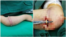 大陸,安徽,女童,橡皮筋,肉環,手臂／微博