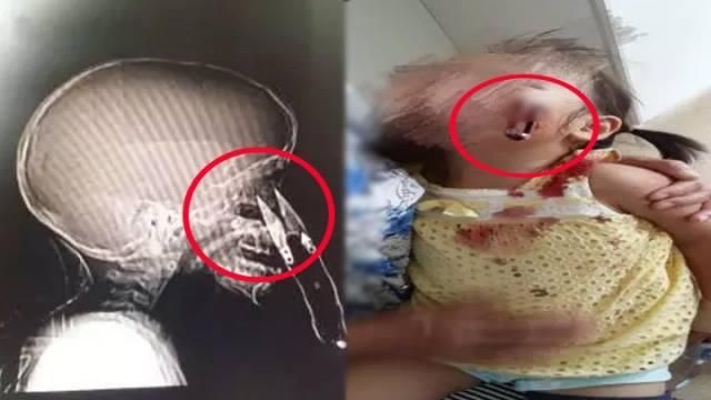 3歲女童摔倒　手上利剪直插入臉險瞎